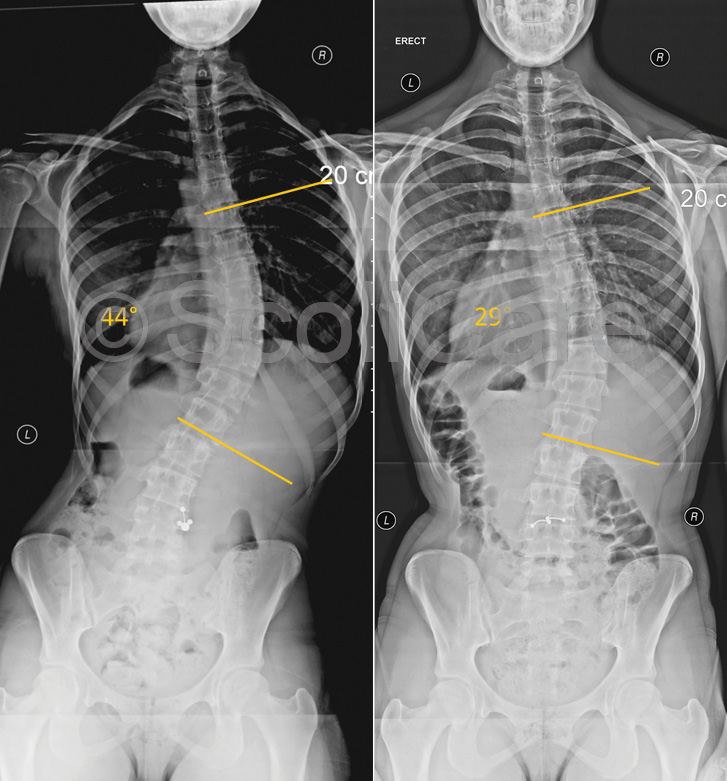 Sydney Scoliosis Clinic x-ray Case 1